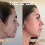 Facelift and neck lift before and after results at Dr. Safa Manav Clinic, visible facial rejuvenation