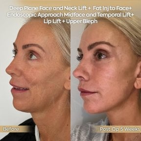 Facelift before and after results at Dr. Safa Manav Clinic – visible facial rejuvenation