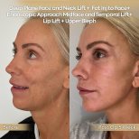 Facelift before and after results at Dr. Safa Manav Clinic – visible facial rejuvenation