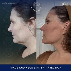 Before and after facelift and neck lift with fat injection at Dr. Safa Manav Clinic results