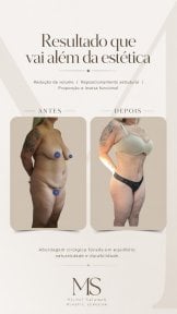 before-after photo abdominal-liposuction
