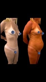 before-after photo abdominal-liposuction
