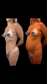 before-after photo abdominal-liposuction