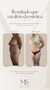 before-after photo tummy-tuck-and-liposuction