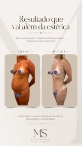 before-after photo tummy-tuck-and-liposuction
