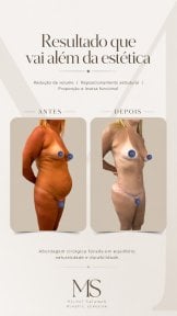 before-after photo tummy-tuck-and-liposuction