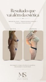 before-after photo tummy-tuck-and-liposuction