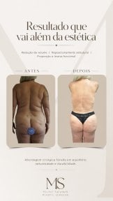 before-after photo tummy-tuck-and-liposuction