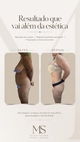 before-after photo tummy-tuck-and-liposuction
