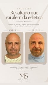 before-after photo tightening-of-facial-skin-facelift