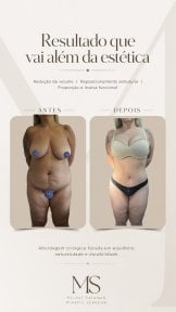before-after photo tummy-tuck-and-liposuction