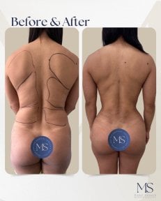 before-after photo tummy-tuck-and-liposuction