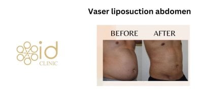 Before and after Vaser liposuction abdomen results at ID Clinic Bangkok, visible fat reduction
