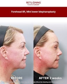 Результати підтяжки чола та міні-блефаропластики в Returning Plastic Surgery через 2 тижні