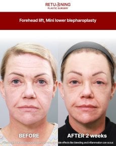 Результати підтяжки чола та міні-блефаропластики в Returning Plastic Surgery через 2 тижні
