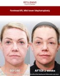 Результати підтяжки чола та міні-блефаропластики в Returning Plastic Surgery через 2 тижні