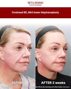 Результати підтяжки чола та міні-блефаропластики в Returning Plastic Surgery, через 2 тижні