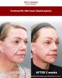 Результати підтяжки чола та міні-блефаропластики в Returning Plastic Surgery, через 2 тижні