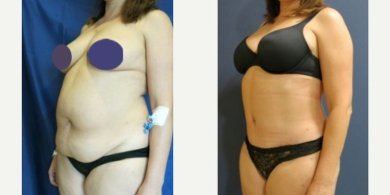 نتائج قبل وبعد عملية تجميل الأم في مستشفى ميموريال غوزتيبي، تحسين شكل الجسم