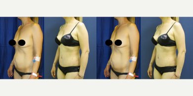 نتائج قبل وبعد عملية تجميل الأم في مستشفى ميموريال غوزتيبي، تحسين شكل الجسم