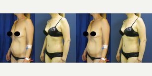 نتائج قبل وبعد عملية تجميل الأم في مستشفى ميموريال غوزتيبي، تحسين شكل الجسم