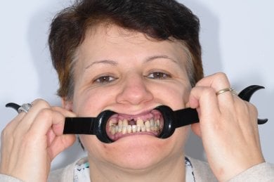 Antes del implante dental en Unident Clinic: pérdida y desalineación dental visible