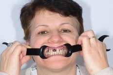 Antes del implante dental en Unident Clinic: pérdida y desalineación dental visible