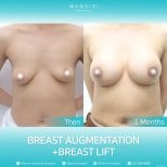 Результаты до и после подтяжки и увеличения груди в Wansiri Hospital, улучшенный контур