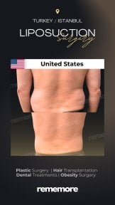 before-after photo abdominal-liposuction