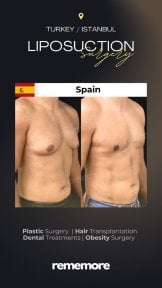 before-after photo abdominal-liposuction