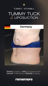 نتائج شد البطن والشفط قبل وبعد في مستشفى ميموريال غوزتيبي إسطنبول
