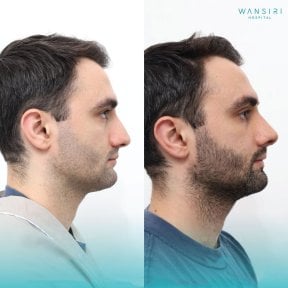 before-after photo rhinoplasty-nose-job