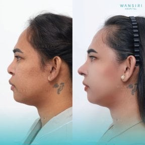 before-after photo rhinoplasty-nose-job