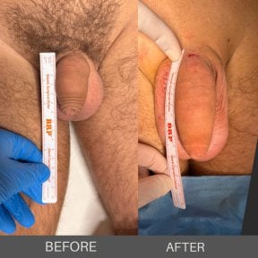 before-after photo penis-enlargement
