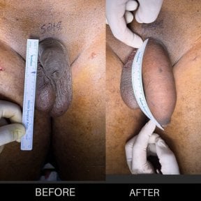 before-after photo penis-enlargement