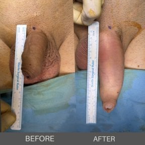 before-after photo penis-enlargement