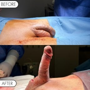 before-after photo penile-implant-surgery