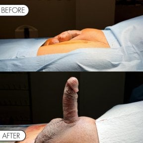 before-after photo penile-implant-surgery