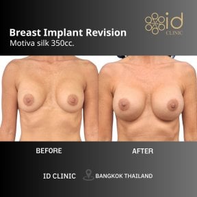 before-after photo vaser-liposuction