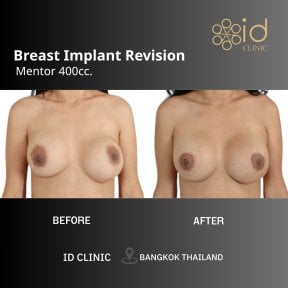 before-after photo vaser-liposuction
