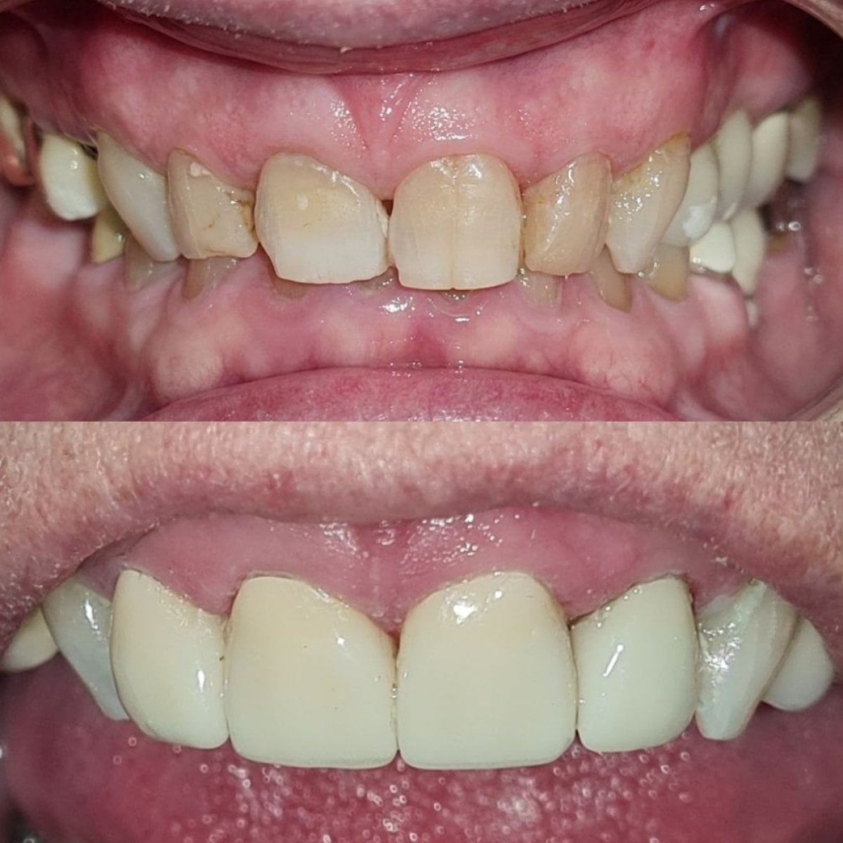 نتائج قبل وبعد تركيب تيجان الأسنان في SoftDentalCare Clinic، ابتسامة محسنة