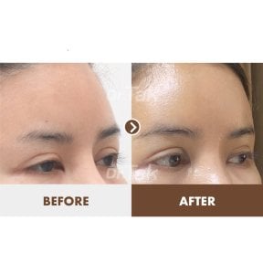 before-after photo fox-eye-surgery