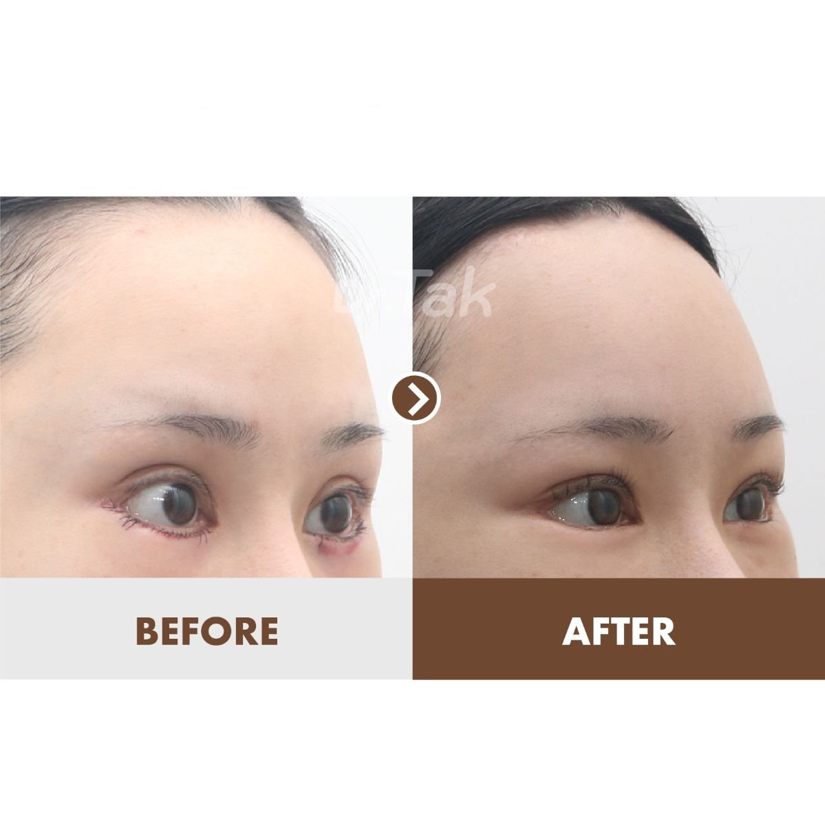 نتائج قبل وبعد Fox Eye Lift في Dr. Tak Plastic Surgery، مظهر جفن مرفوع