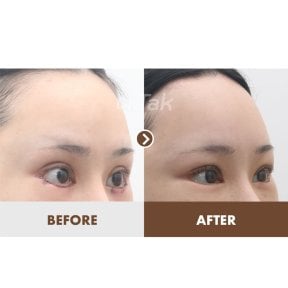 before-after photo fox-eye-surgery