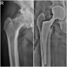 before-after photo hip-replacement