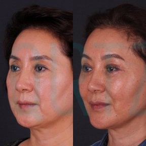 Before and after Deep Plane Facelift results at Quartz Hospital, visible facial rejuvenation