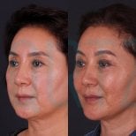 Before and after Deep Plane Facelift results at Quartz Hospital, visible facial rejuvenation