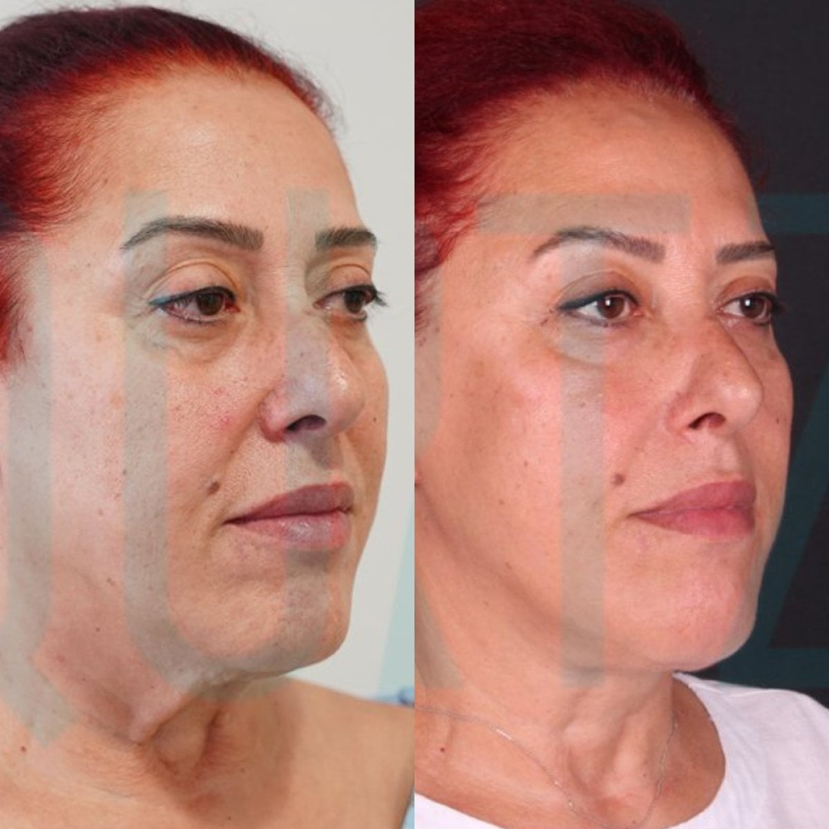 نتائج قبل وبعد شد الوجه العميق في Quartz Hospital، تجديد شباب الوجه الملحوظ