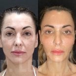 Before and after deep plane facelift results at Quartz Hospital, facial rejuvenation visible