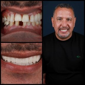 Resultados de implantes dentales antes y después en Mira Clinic, sonrisa restaurada y dientes alineados